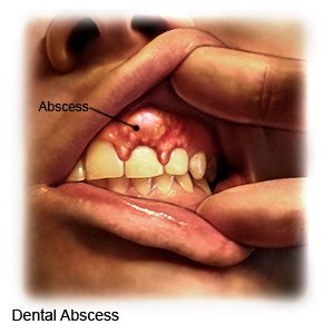 Effective Treatments for Dental Abscesses Effective Treatments for Dental Abscesses