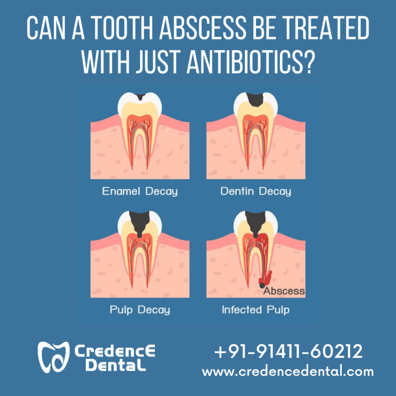 Effective Treatments for Dental Abscesses Effective Treatments for Dental Abscesses