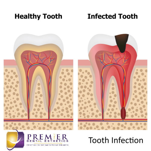 Effective Treatments for Dental Abscesses Effective Treatments for Dental Abscesses
