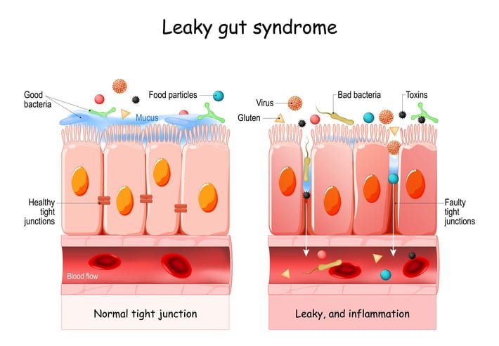 Effective Treatments for Leaky Gut Syndrome