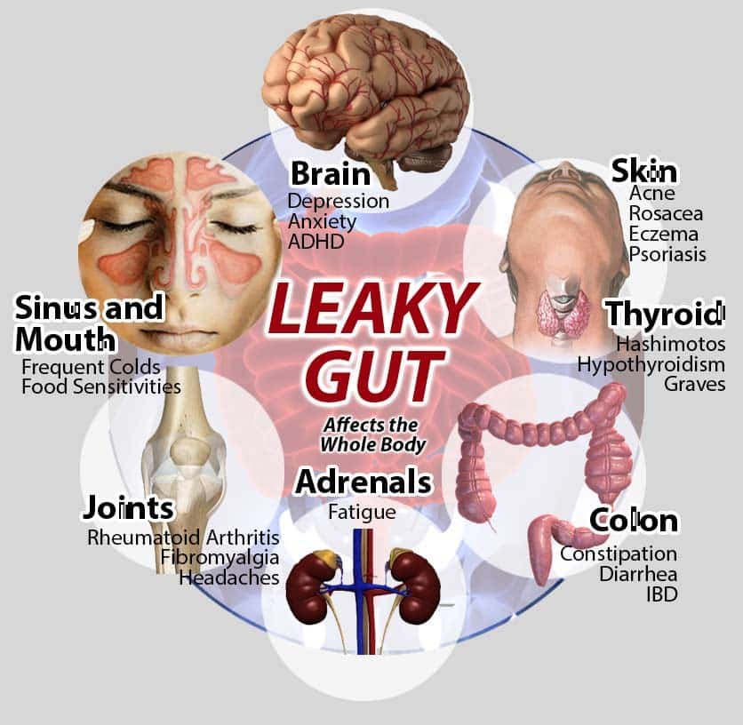 Effective Treatments for Leaky Gut Syndrome