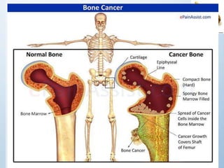 Exploring Different Types of Bone Tumors