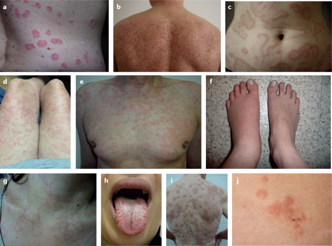 Exploring Different Types of Urticaria: A Comprehensive Guide