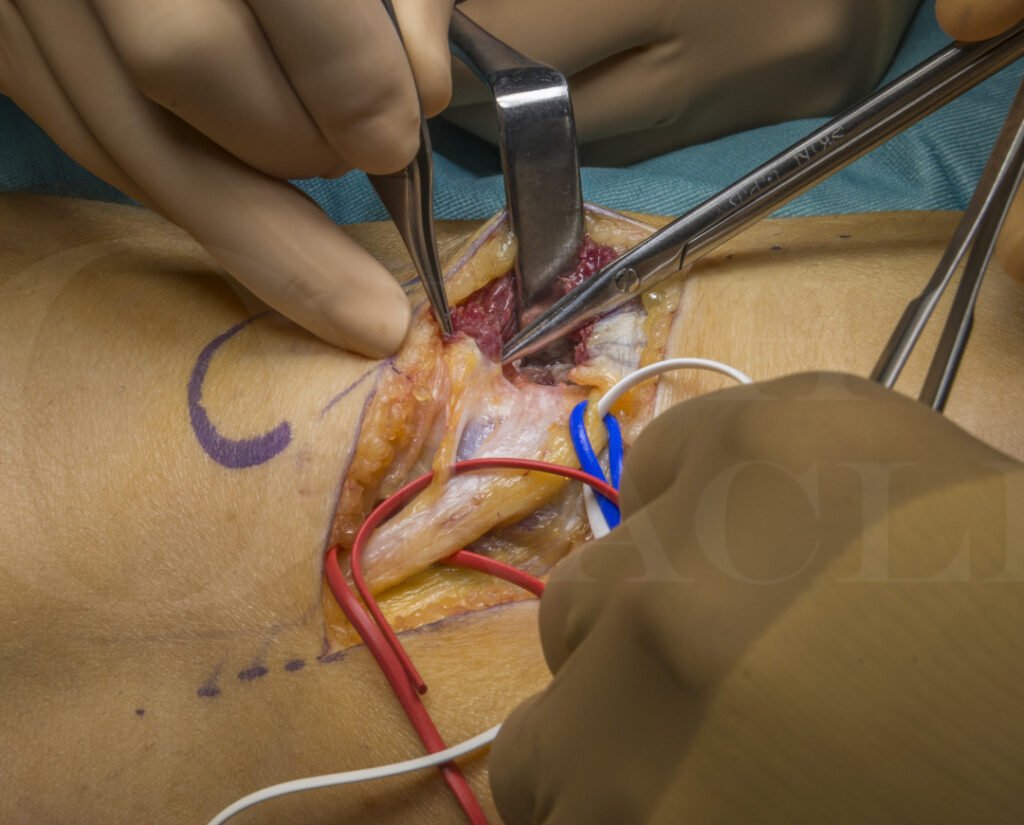 Exploring Ganglion Cyst Removal: Surgical Procedures and Recovery