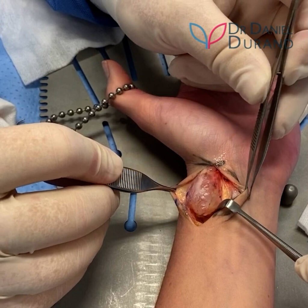Exploring Ganglion Cyst Removal: Surgical Procedures and Recovery