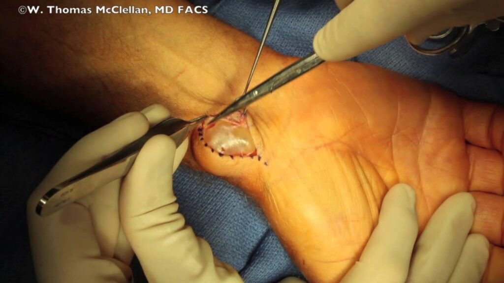 Exploring Ganglion Cyst Removal: Surgical Procedures and Recovery