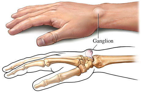 Exploring Ganglion Cyst Removal: Surgical Procedures and Recovery