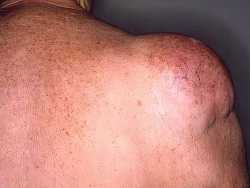 Exploring Lipoma: What You Need to Know
