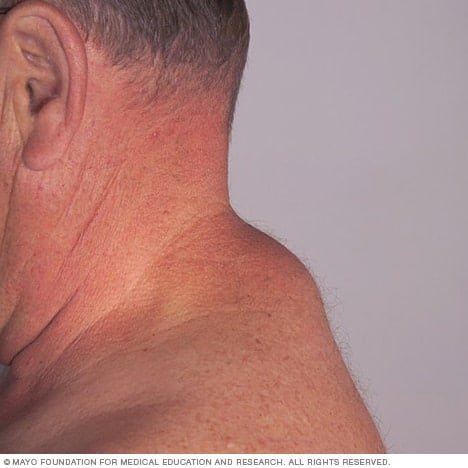 Exploring Lipoma: What You Need to Know