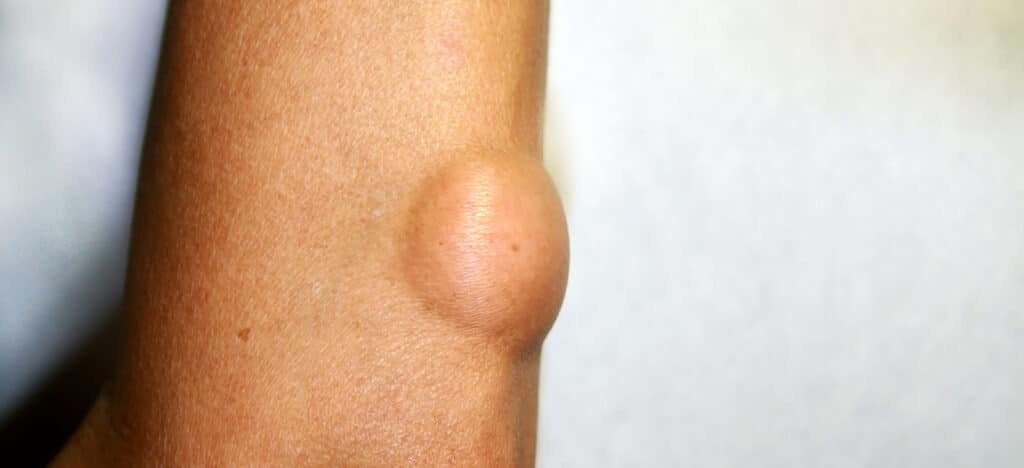 Exploring Lipoma: What You Need to Know
