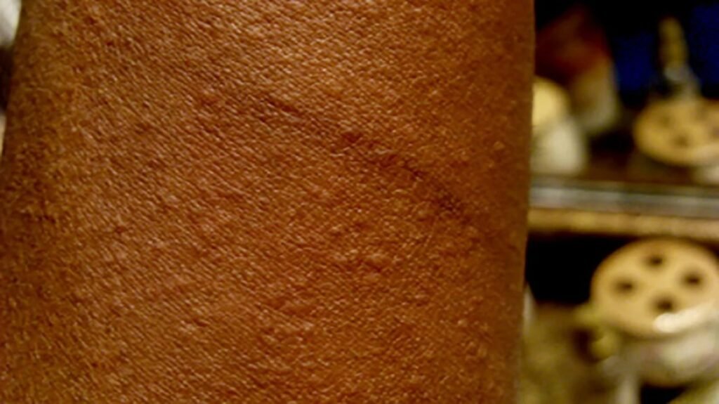 Exploring the Link Between Angioedema and Allergies