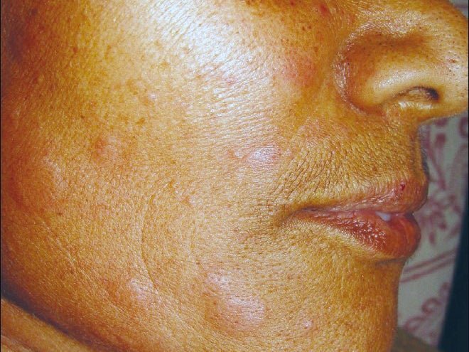 Exploring the Link Between Angioedema and Allergies