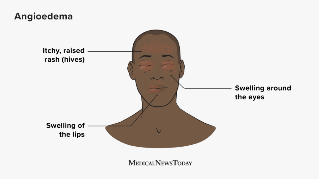 Exploring the Link Between Angioedema and Allergies
