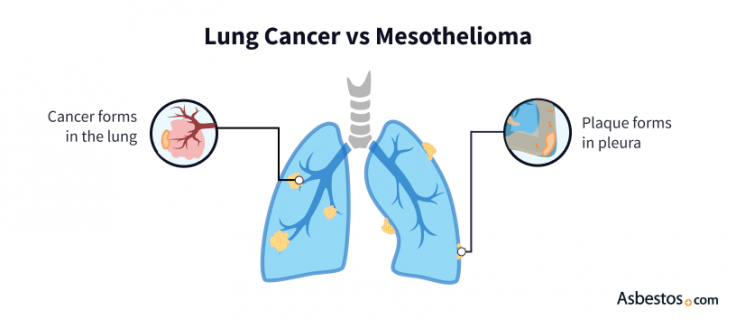 Exploring the Link between Asbestos and Cancer