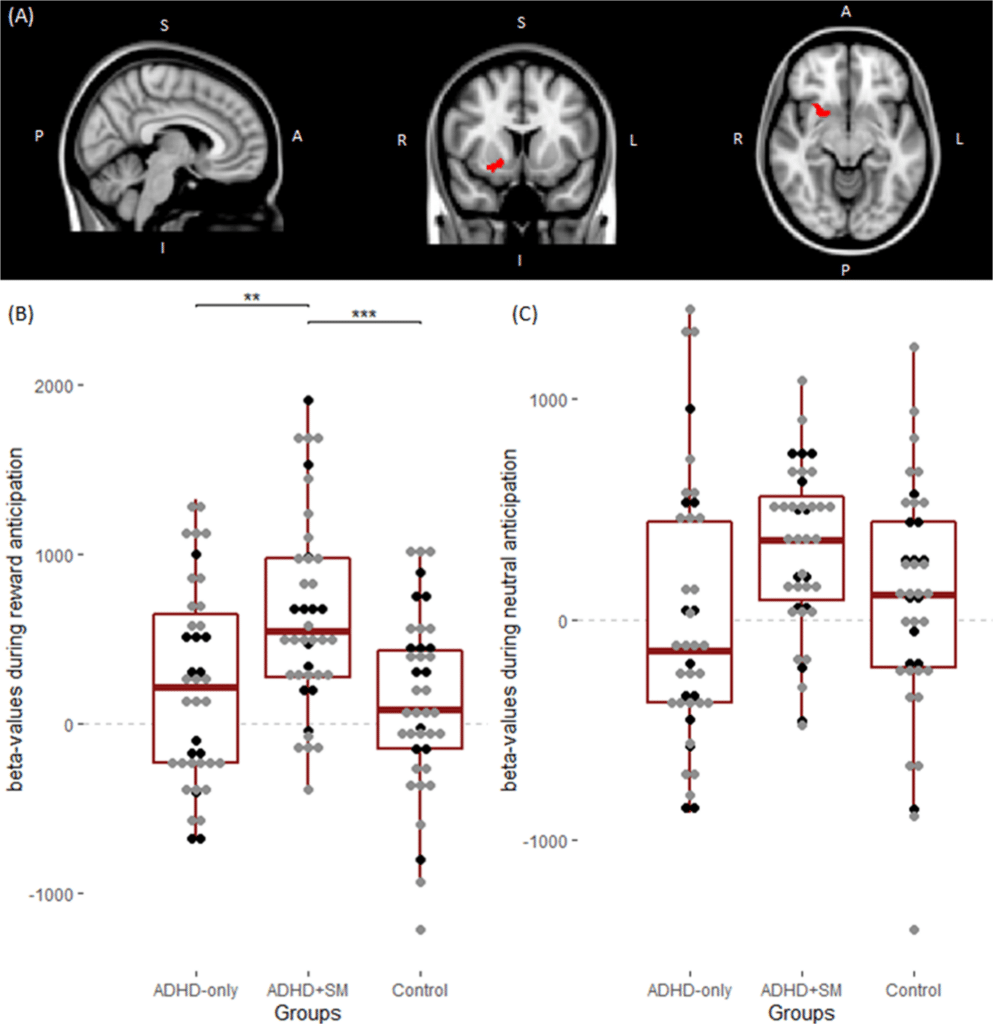 Exploring the Link Between Attention Deficit Hyperactivity Disorder and Substance Abuse