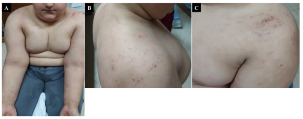 Exploring the Link Between Gluten and Dermatitis Herpetiformis Exploring the Link Between Gluten and Dermatitis Herpetiformis