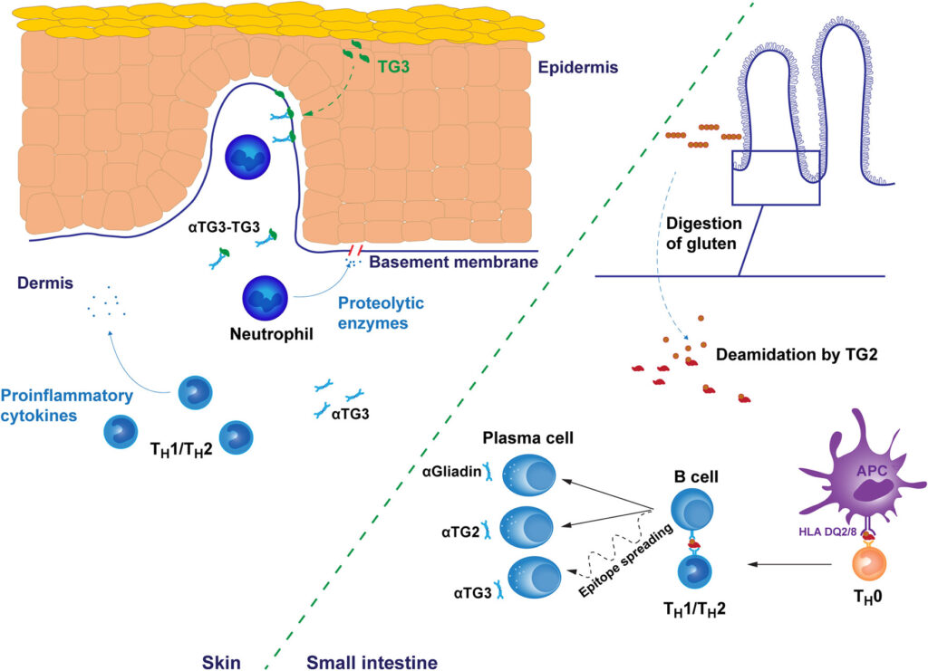 Exploring the Link Between Gluten and Dermatitis Herpetiformis Exploring the Link Between Gluten and Dermatitis Herpetiformis