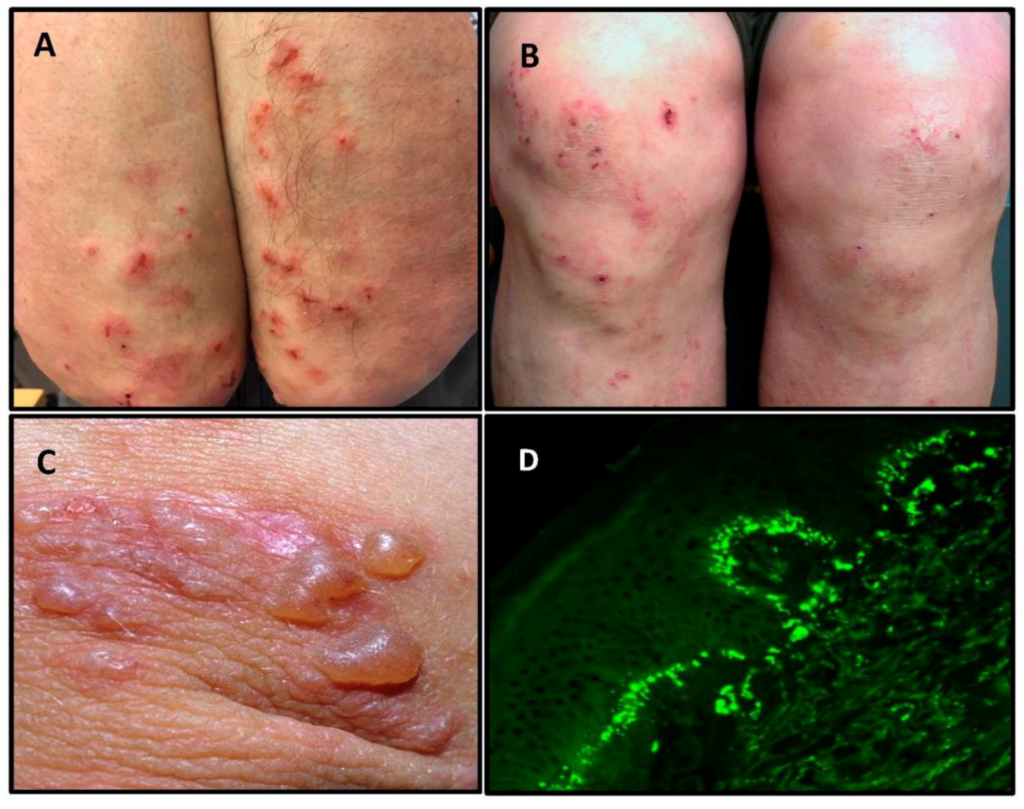 Exploring the Link Between Gluten and Dermatitis Herpetiformis Exploring the Link Between Gluten and Dermatitis Herpetiformis