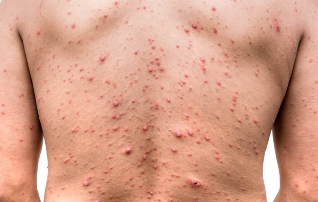 Exploring the Link Between Zoster-Herpes Virus and Shingles