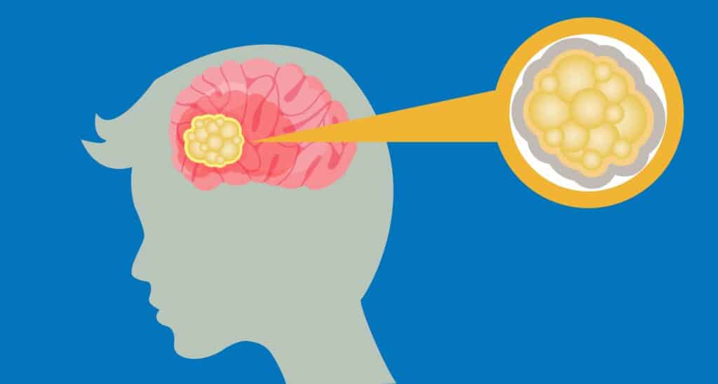 Exploring the Symptoms of Meningioma