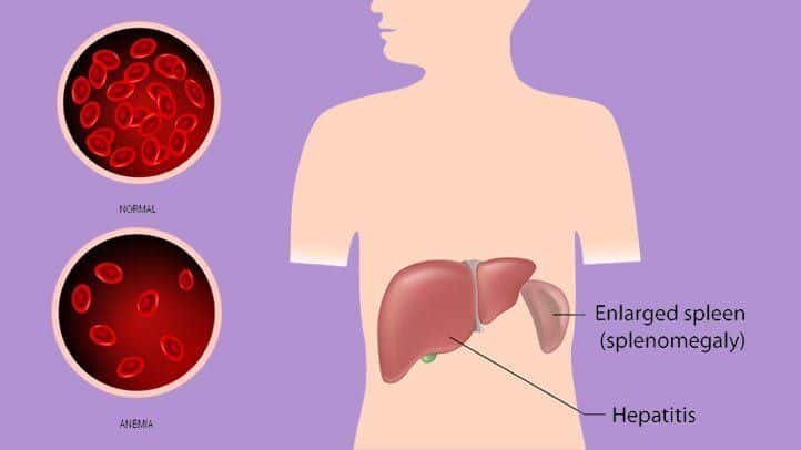 Exploring the Various Complications of Mononucleosis
