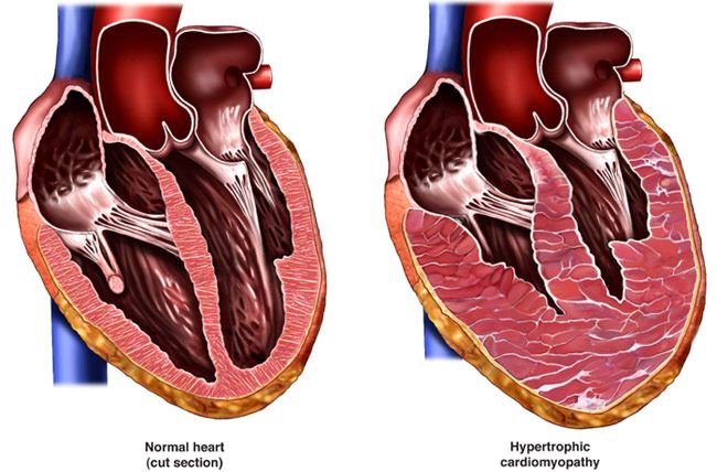 Genetic Testing for Inherited Heart Conditions