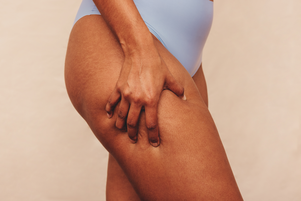 Get Rid of Cellulite: Tips and Tricks That Work