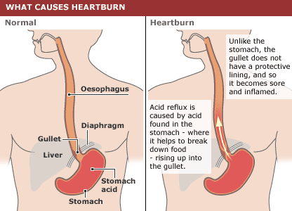 Heartburn vs. Acid Reflux: Whats the Difference?