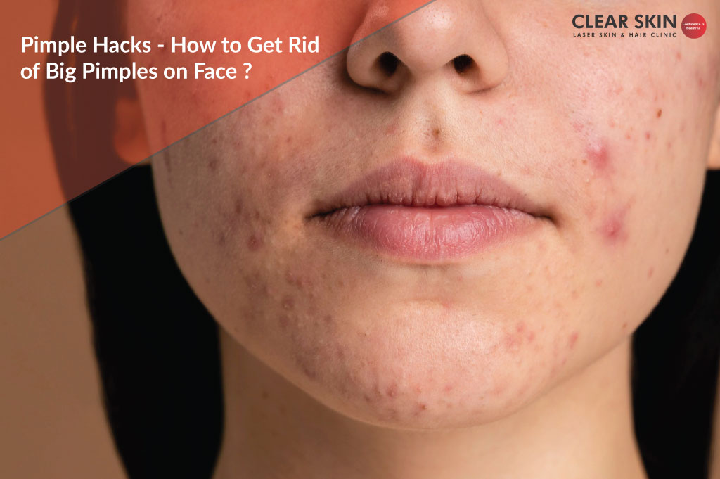 How Can I Clear Acne Pimples?
