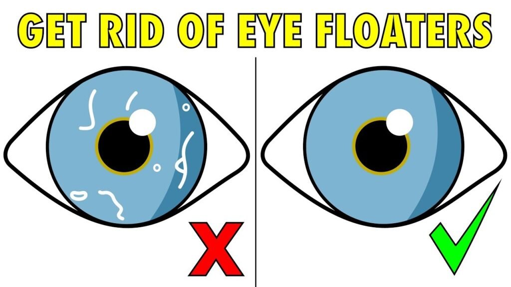 How to Deal with Eye Floaters: Tips and Remedies