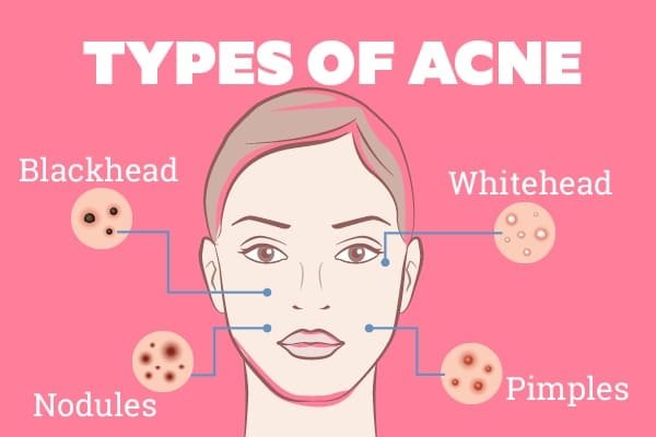 How to Get Rid of Zits How to Get Rid of Zits