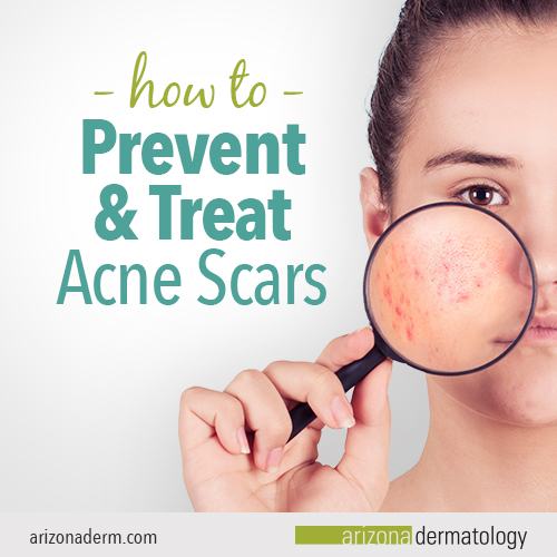 How To Prevent Acne Ask The Nurse Expert