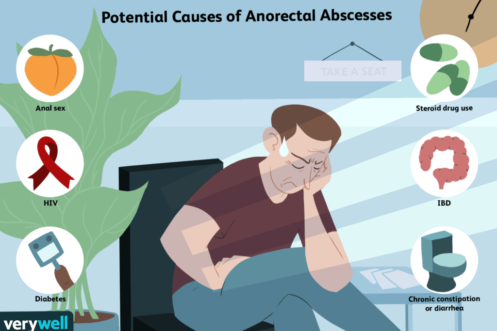 How To Prevent Anal Abscess-Anal Bleeding