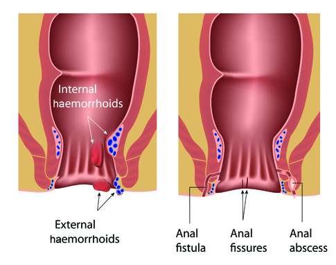 How To Prevent Anal Abscess-Anal Bleeding