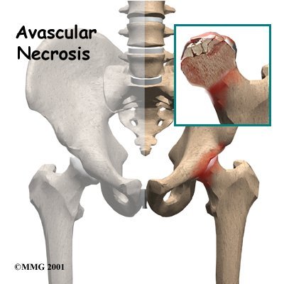 How To Prevent Avascular Necrosis
