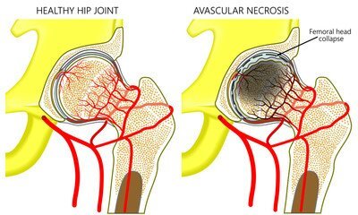 How To Prevent Avascular Necrosis