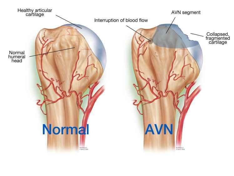 How To Prevent Avascular Necrosis