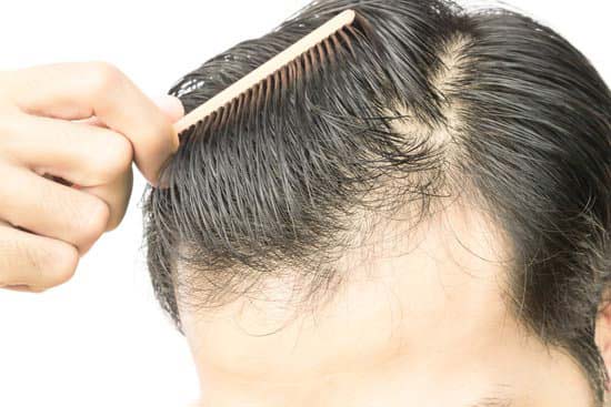 How To Prevent Balding