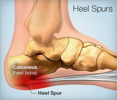 How To Prevent Bone Spurs