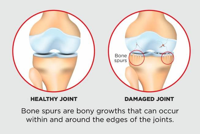 How To Prevent Bone Spurs
