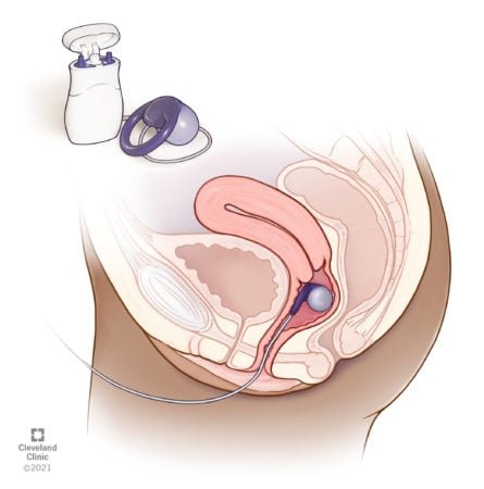 How To Prevent Bowel Incontinence