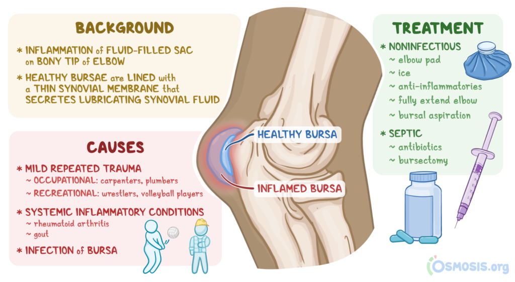 How To Prevent Bursitis How To Prevent Bursitis