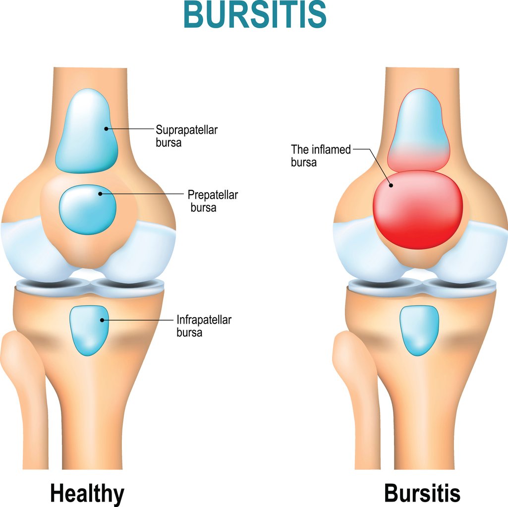 How To Prevent Bursitis How To Prevent Bursitis