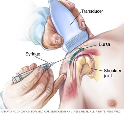 How To Prevent Bursitis How To Prevent Bursitis