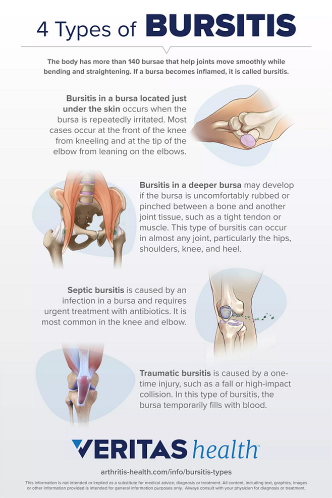 How To Prevent Bursitis How To Prevent Bursitis
