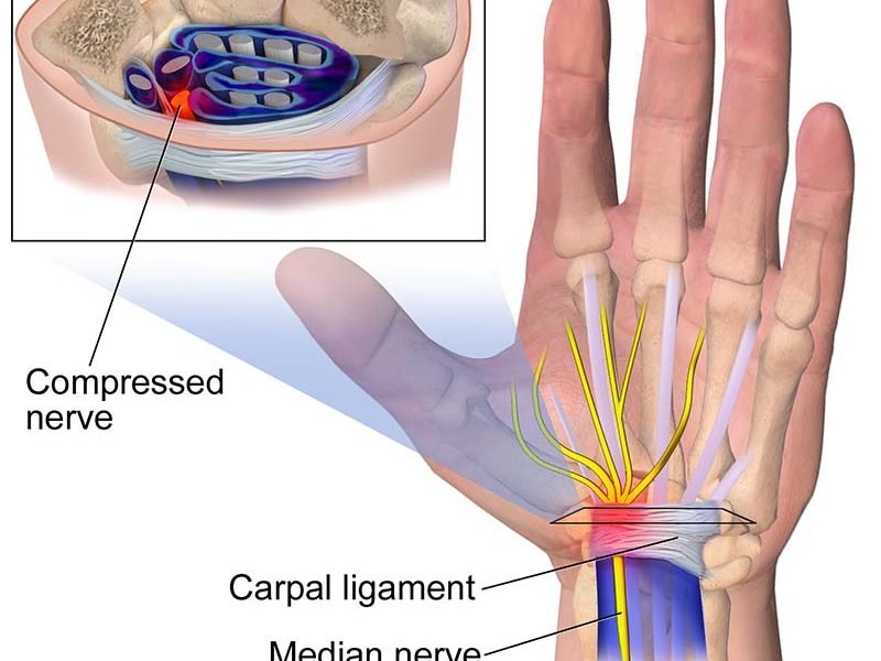 How To Prevent Carpal Tunnel Syndrome