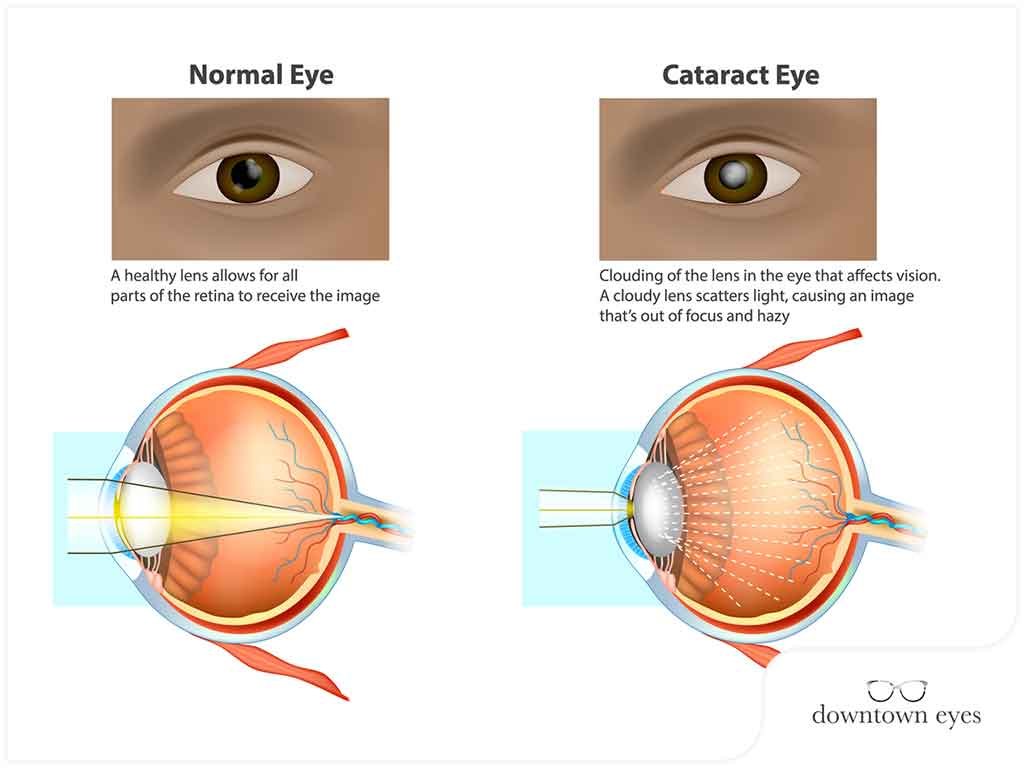 How To Prevent Cataracts