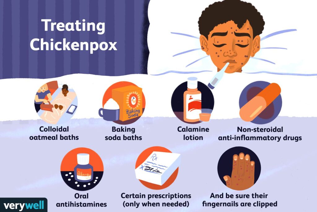How To Prevent Chicken Pox