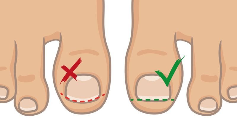 How To Prevent Ingrown Toenail
