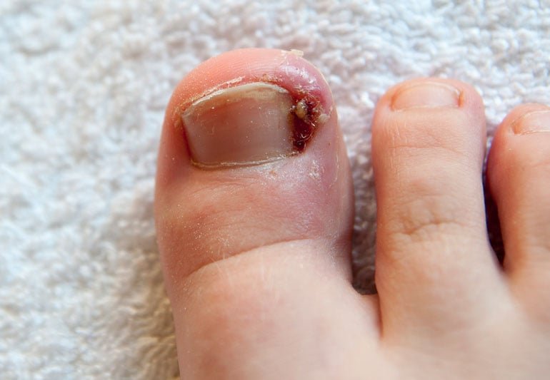 How To Prevent Ingrown Toenail